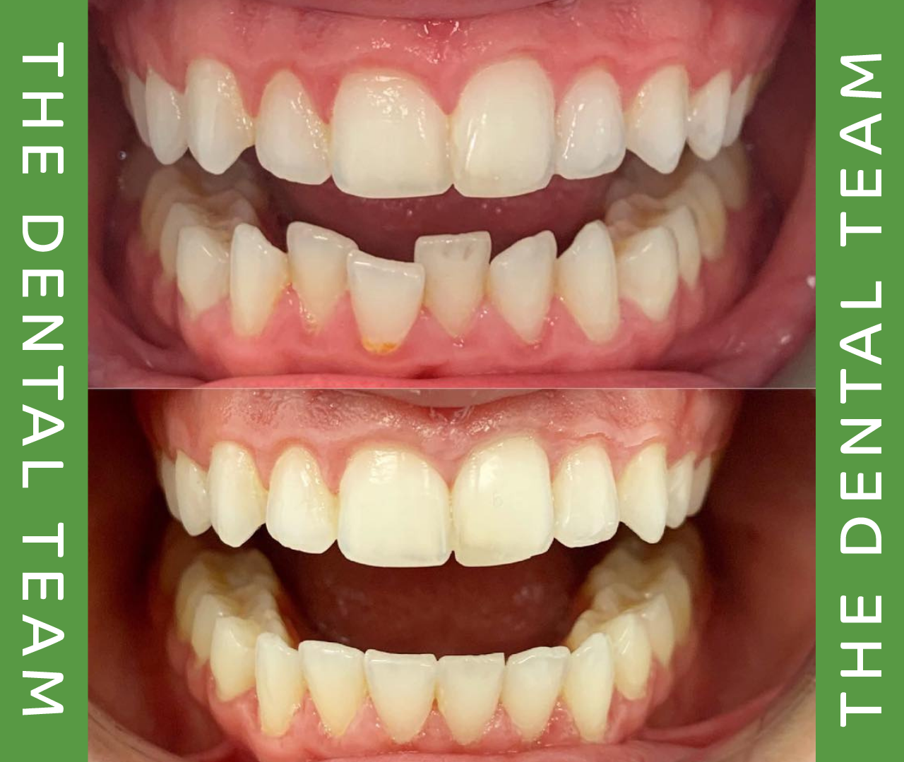 Invisalign Teeth Straightening Dental Treatment Stretford Trafford Greater Manchester