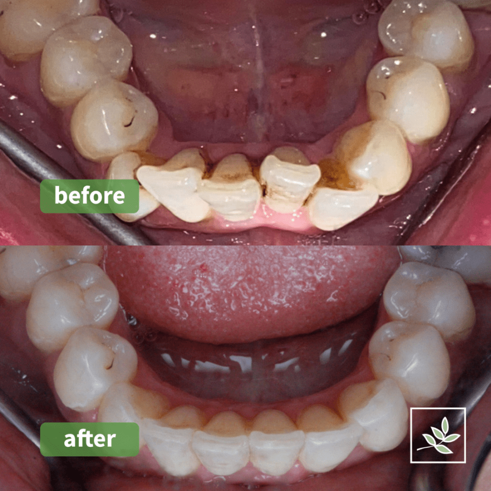 Dental Team Invisalign Manchester Straight Teeth Stretford